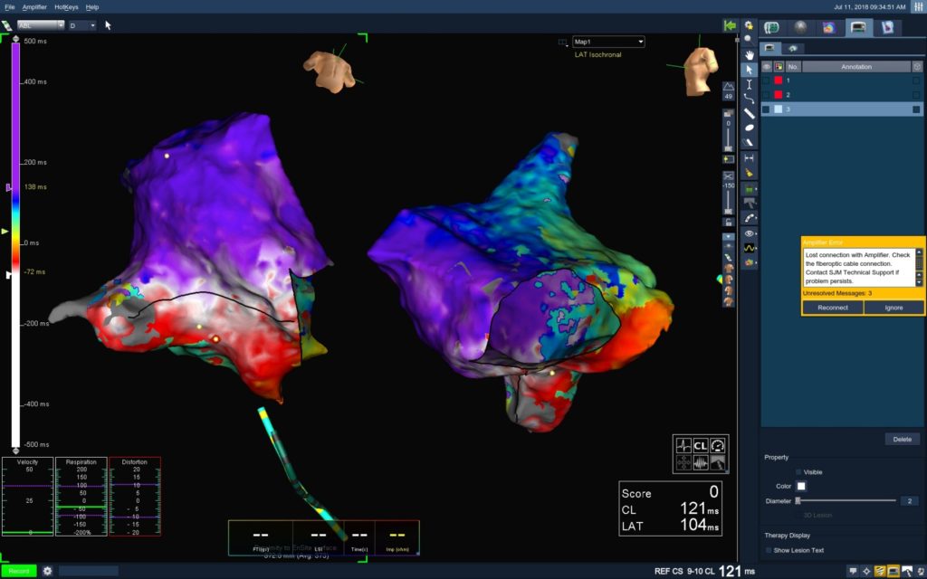 complications of atrial flutter ablation